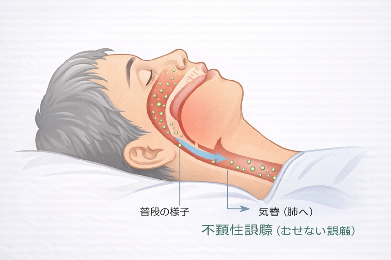 睡眠中に唾液が肺に流れ込む不顕性誤嚥のメカニズム図。