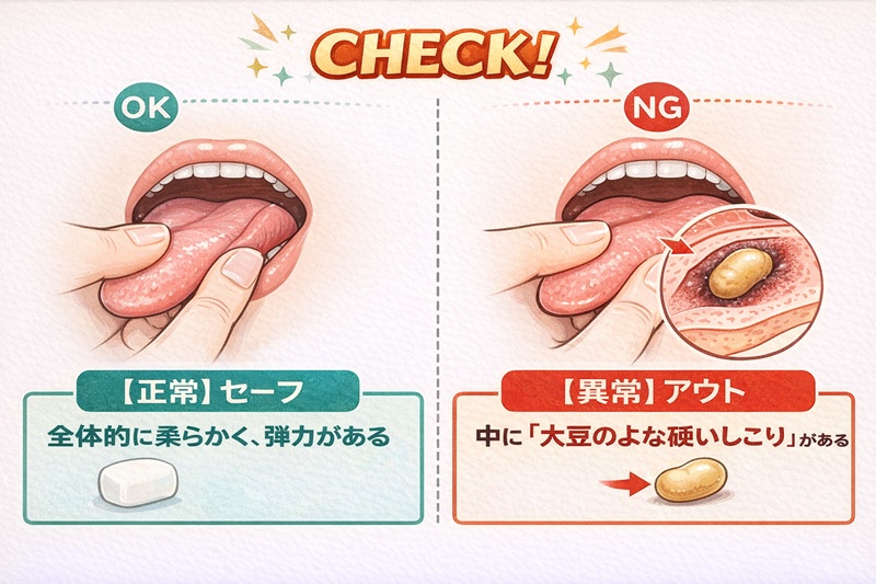 舌がんのセルフチェック方法のイラスト。指で患部を挟み、中に硬いしこり（硬結）があるかどうかを確認している様子。