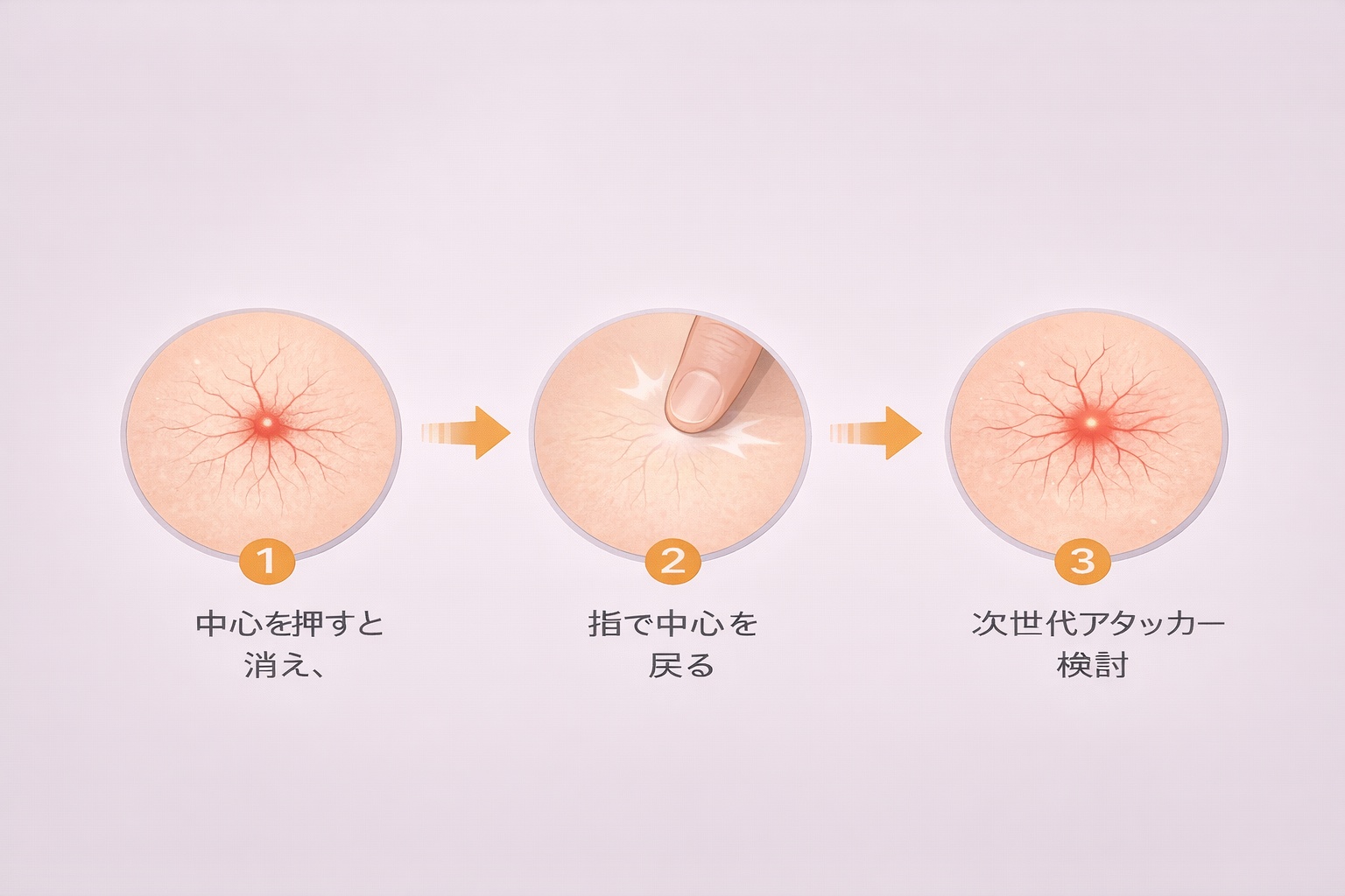 クモ状血管腫の構造と、指で押して血流を確認するセルフチェックの手順図。