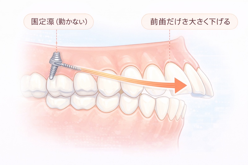 歯科矯正用アンカースクリューの仕組み。奥歯を固定源にせず、スクリューを支点に前歯を後退させる図。