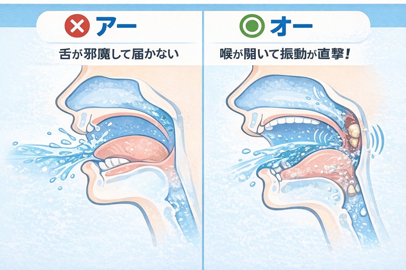 「アー」と「オー」の発声による喉の開き方の違いと、膿栓を排出する正しい振動うがいの図解